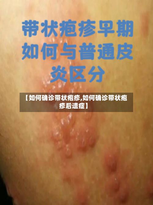 【如何确诊带状疱疹,如何确诊带状疱疹后遗症】