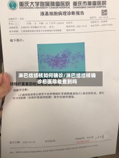 淋巴结结核如何确诊/淋巴结结核确诊后医院能查到吗-第3张图片