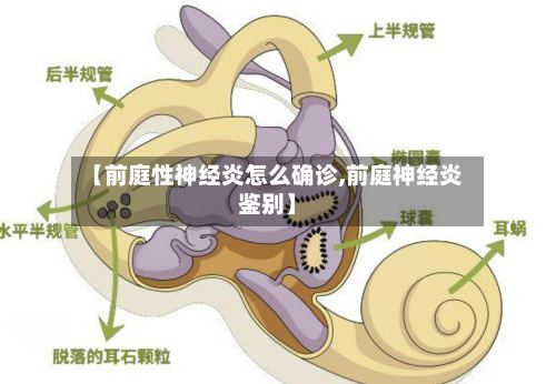 【前庭性神经炎怎么确诊,前庭神经炎鉴别】