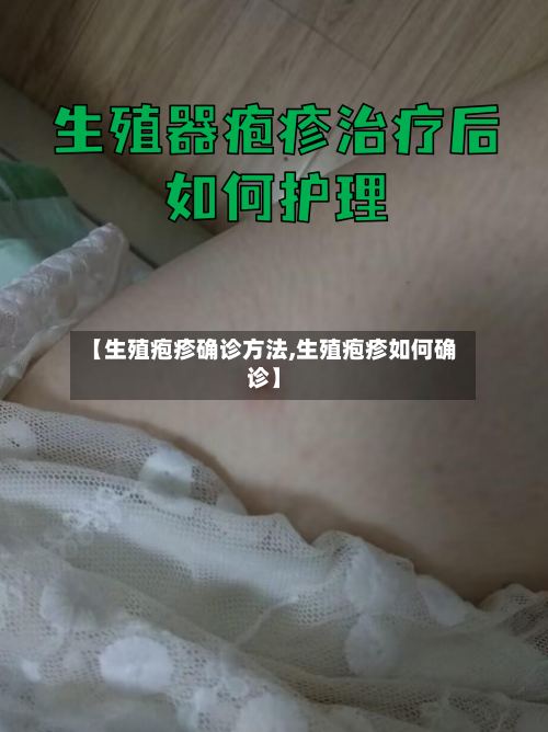 【生殖疱疹确诊方法,生殖疱疹如何确诊】