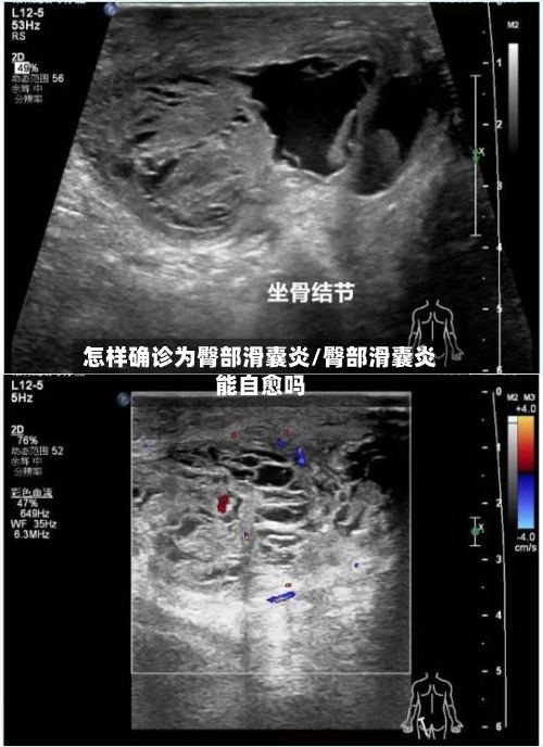 怎样确诊为臀部滑囊炎/臀部滑囊炎能自愈吗