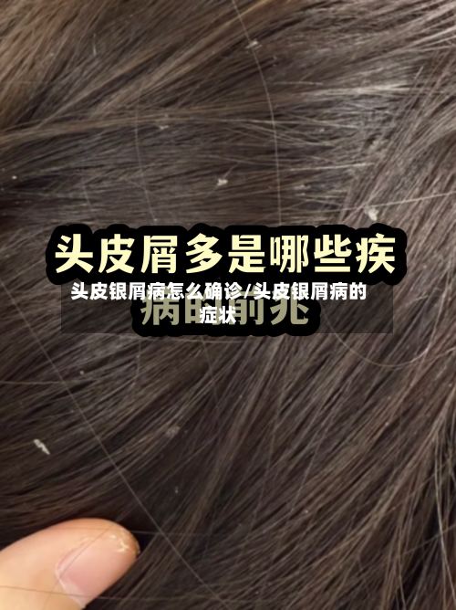 头皮银屑病怎么确诊/头皮银屑病的症状-第2张图片