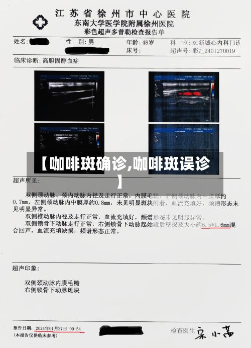 【咖啡斑确诊,咖啡斑误诊】